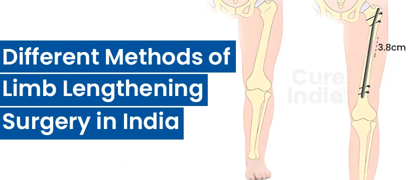 Techniques for Limb Lengthening Surgery in India